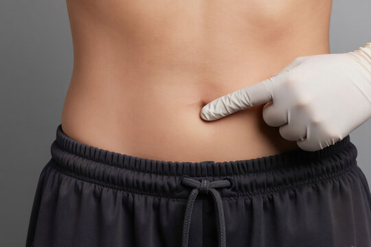 Doctor in glove points finger to skin tag on belly. Examining growth for medical checkup. Dermatologist consults patient about skin condition and treatment.