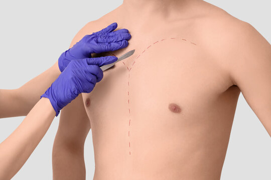 Plastic surgeon with scalpel and markings on man's chest against light background, closeup