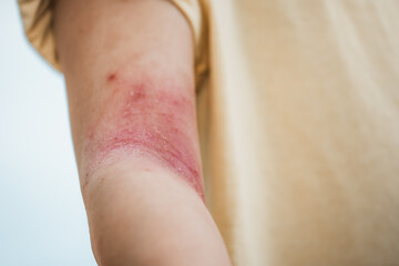 Fototapeta premium Close-up of a child's inner elbow with severe red, scaly skin rash, indicating atopic dermatitis or eczema. Ideal for pediatric medical and dermatology healthcare education materials.
