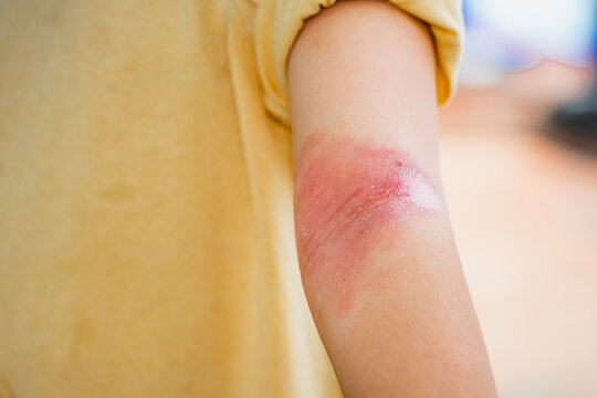 Close-up of child's arm showing red, inflamed, and dry skin in the antecubital fossa. This condition is commonly associated with atopic dermatitis, characterized by redness, irritation, inflammation.