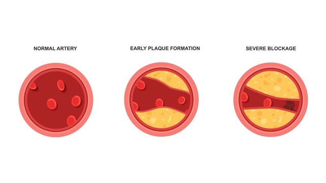 Medical Animation Showing The Progression Of Plaque Buildup Inside An Artery. Blood Plaque Formation Stages and Artery Blockage.  Cardiovascular Disease or Atherosclerosis.