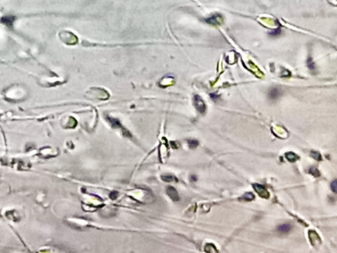 Normozoospermia, normal sperm count. Sperm analysis on microscopic examination.