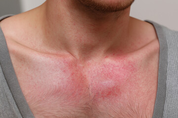 Naklejka premium Redness rash chest neck skin irritation inflammation itchy skin irritation sore chest