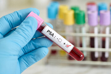 Obraz premium Hand in blue glove holding positive PSA blood test tube