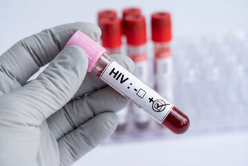 Fototapeta premium Hand in grey glove holding positive HIV blood test tube
