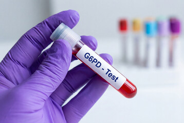 Fototapeta premium Hand in purple glove holding blood sample tube labeled g6pd test in lab