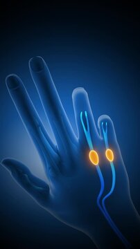 Stiffness and Pain in Hand from Dupuytren&rsquo;s Contracture