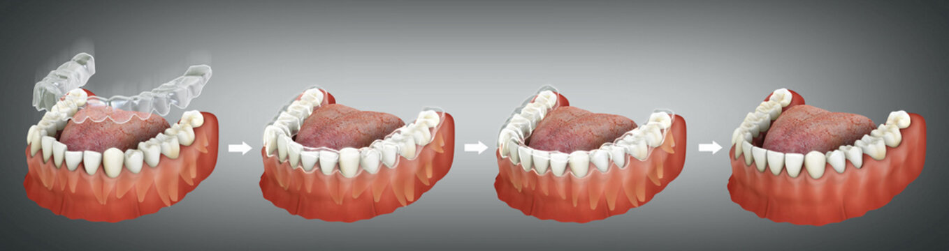 How Clear aligners or Invisalign work - A comprehensive 3D illustration. 