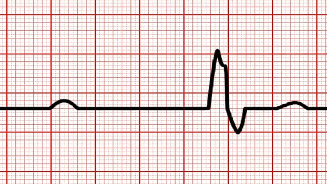 Electrocardiogram ECG waveform on grid paper showing heart rhythm activity. Used in cardiology, diagnostics, arrhythmia detection, and clinical monitoring concepts.