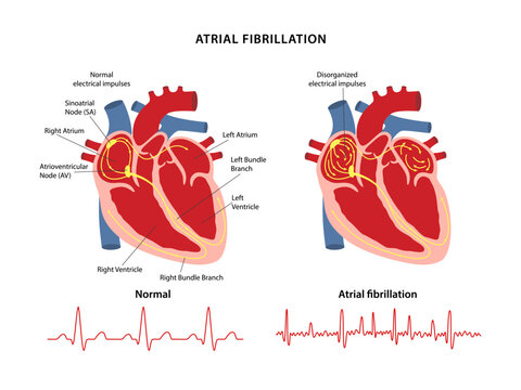 Atrial fibrillation. Comparison of electrocardiograms of normal heartbeat and those of atrial fibrillation. Vector illustration in flat style isolated on white background.