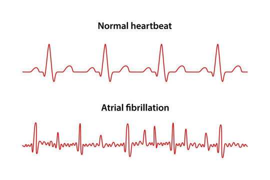 Atrial fibrillation. Comparison of electrocardiograms of a normal heartbeat and those of atrial fibrillation. Heart cardiogram. Vector illustration in flat style isolated on white background
