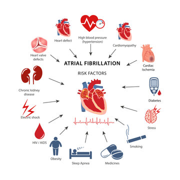 Diagram of risk factors for atrial fibrillation in humans. Flat style vector illustration isolated on a white background.