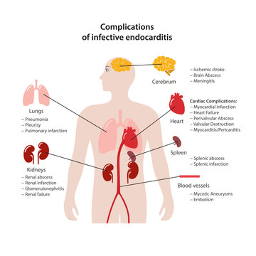 Complications of infective endocarditis. An image of the human body with key affected organs labeled. Flat style vector illustration isolated on a white background.