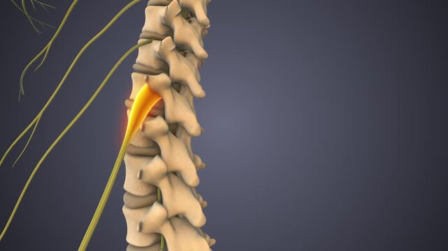 Lumbosacral Radiculopathy with Nerve Compression