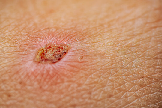 Close-up view of a healing wound on human skin showing redness and scab formation, highlighting the texture and details of the skin surface
