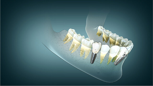 Dental implant with lower jawbone aligning beautifully with healthy teeth. Medically approved illustration.