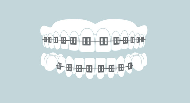 Healthy human teeth with dental braces for orthodontic treatment on a pale blue background