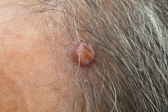 Close-up of scalp cyst (sebaceous cyst), small lump on human scalp caused by blocked oil glands, common skin condition, healthcare and dermatology concept