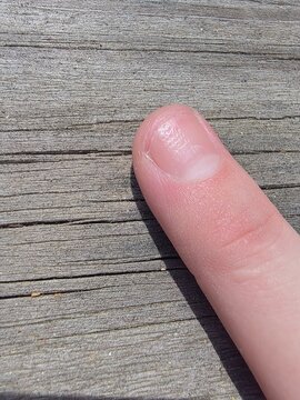 Nail pitting