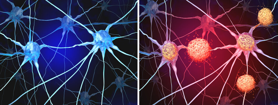 Sting Pathway or stimulator of interferon genes Neurology and Alzheimer's Sting Switch as a scientific discovery as a molecular mechanism that trigger