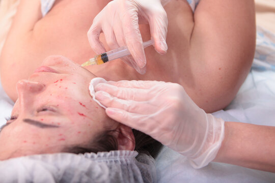 Plasmolifting injections in beauty salon .Plasmolifting procedure. Cosmetologist's hands. Close-up of patient's face. Concept of cosmetology. Patient's face is out of focus.