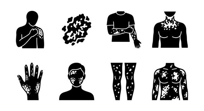  Vitiligo and Skin Disease Icon Set - Depigmentation Patches on Body Parts - Medical Vector Illustrations