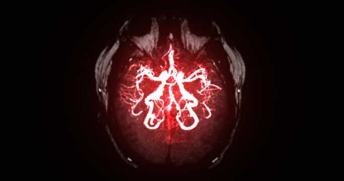 High-tech glowing red Magnetic Resonance Angiography (MRA) of human brain blood vessels on a dark background. Ideal for stroke, neurology, and medical research concepts.