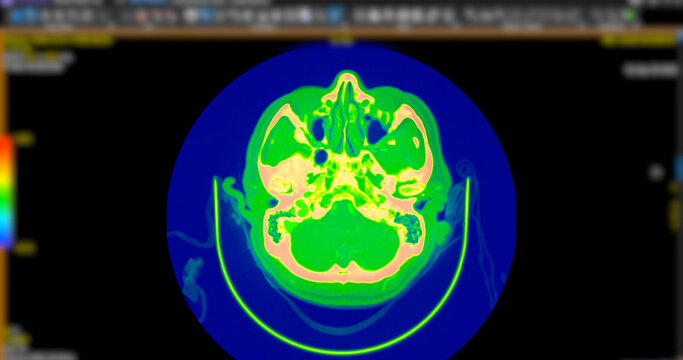 High-resolution Computed Tomography Angiography (CTA) scan showcasing the human brain and carotid arteries in the neck. Essential for diagnosing stroke, stenosis, and vascular health