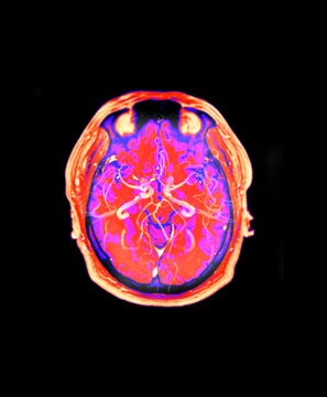 Authentic axial MRI scan of a human head showing the brain, eyes, and orbits with a glowing red clinical highlight. Ideal for neuroscience, ophthalmology, and advanced medical diagnostics.
