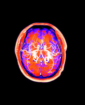 Authentic axial MRI scan of a human head showing the brain, eyes, and orbits with a glowing red clinical highlight. Ideal for neuroscience, ophthalmology, and advanced medical diagnostics.