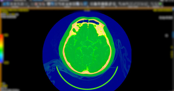High-resolution Computed Tomography Angiography (CTA) scan showcasing the human brain and carotid arteries in the neck. Essential for diagnosing stroke, stenosis, and vascular health