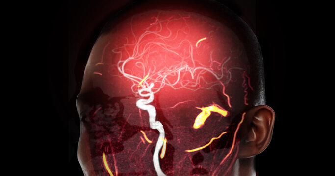 High-tech glowing red Magnetic Resonance Angiography (MRA) of human brain blood vessels on a dark background. Ideal for stroke, neurology, and medical research concepts.