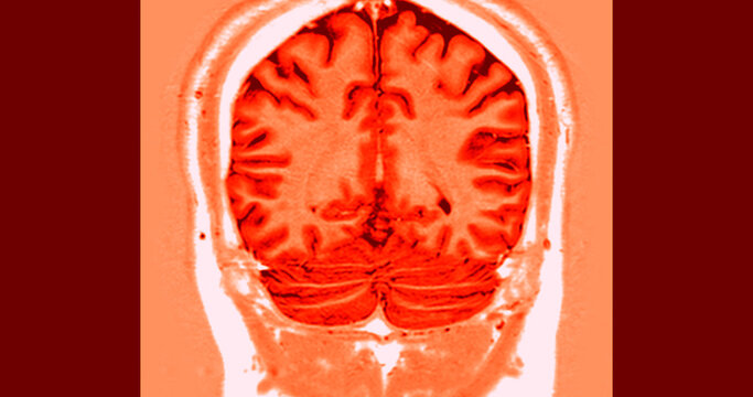 High-resolution authentic coronal MRI scan of a human brain highlighting the hippocampus with vivid pink color mapping. Ideal for neurology, memory research, and medical diagnostics.