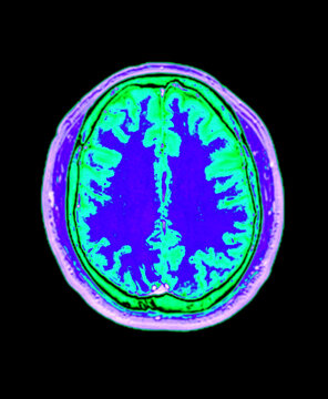 Authentic axial MRI scan of a human brain utilizing blue and green false color mapping for enhanced structural contrast. Ideal for neuroscience research and futuristic medical tech.
