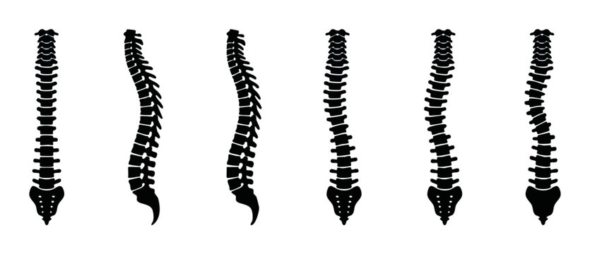 Human Spine Anatomy Vector Set, Spinal Column Deformities, Scoliosis, Kyphosis, and Lordosis Curves, Medical Icons for Orthopedic Diagnosis, Chiropractic Treatment Education, Isolated Black Silhouette