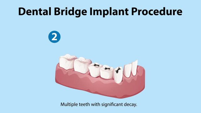 Dental bridge implant procedure with detailed visual steps of healthy teeth gums multiple teeth significant decay decayed teeth removed dental