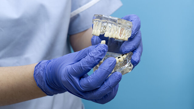 Dentist in blue gloves demonstrating a dental implant and artificial crown on a transparent jaw model.