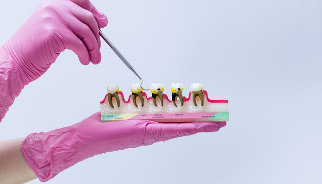 Dentist holding a periodontal disease model. Stages of gingivitis, periodontitis, and bone loss anatomy concept.