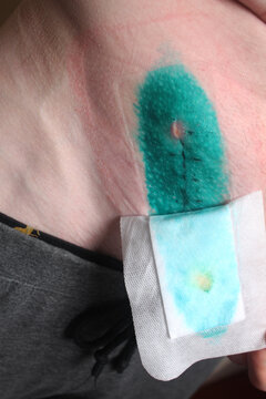 Close-up of a scar on the abdomen. Recovery after surgery