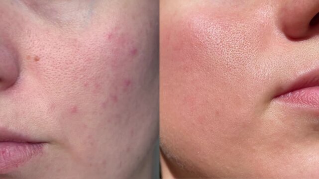 Side by side comparison of female face showing acne skin and improved smooth complexion. Skincare, cosmetic treatment and beauty results concept.