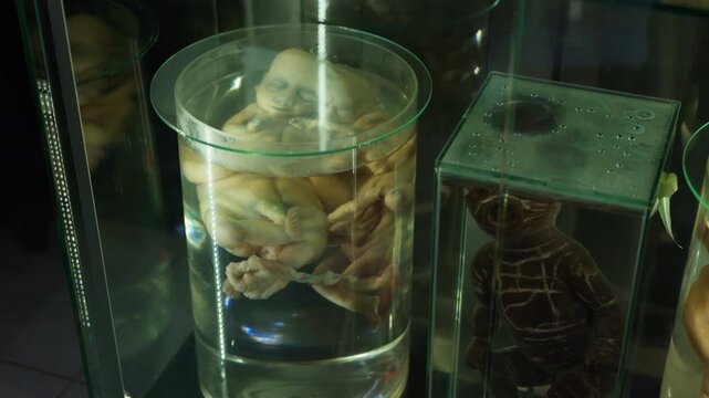 Exhibition of anatomical exhibits. A human infant with the pathological development of anencephaly