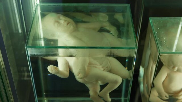 Exhibition of anatomical exhibits. A human infant with the pathological development of anencephaly