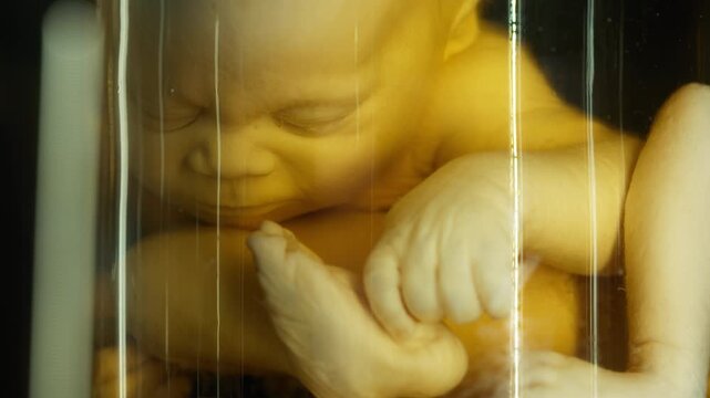 Exhibition of anatomical exhibits. A human infant with the pathological development of anencephaly