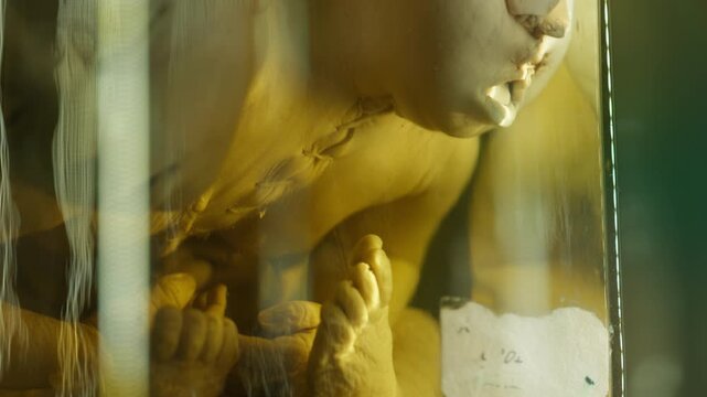 Exhibition of anatomical exhibits. A human infant with the pathological development of anencephaly