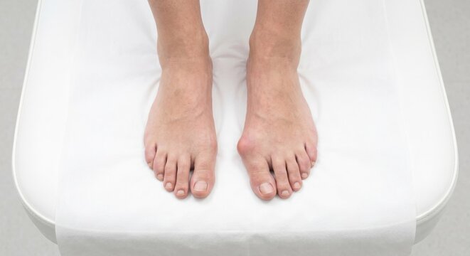 Comparison of healthy foot and foot with hallux valgus bunion