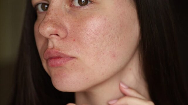 Depressed woman looking at problematic skin with acne and post-acne marks, skincare concept, extreme close-up face