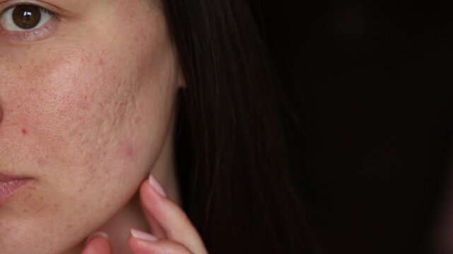 Close-up portrait of young woman with acne and post-acne scars examining her skin, concerned expression