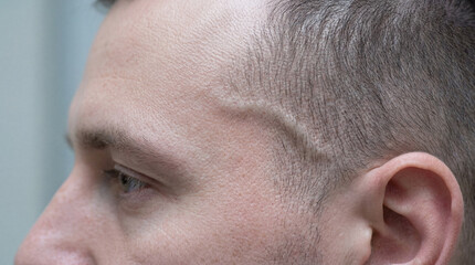 Fototapeta premium Contemplative man's profile captured in serene light, showcasing a distinct temporal vein and fine facial features