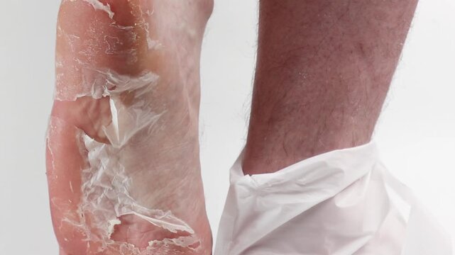 Close-up of a man's leg with peeling skin on the feet. Dry skin from the sole of foot sole. White background. Jib shot. Concept of cosmetic skin care and pedicure