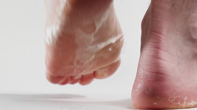 Close-up of male legs with severe peeling. One foot itches against the other due to irritation and itching. Dermatology and eczema.